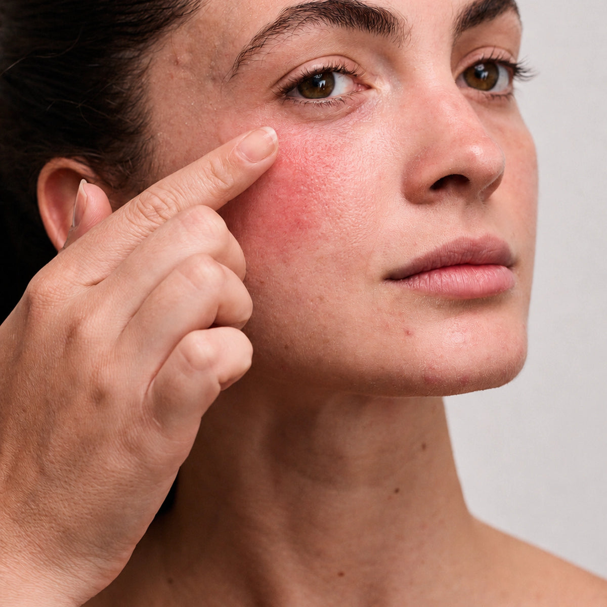 Close-up of a woman pointing to a patch of redness and irritation on her cheek against a neutral background.